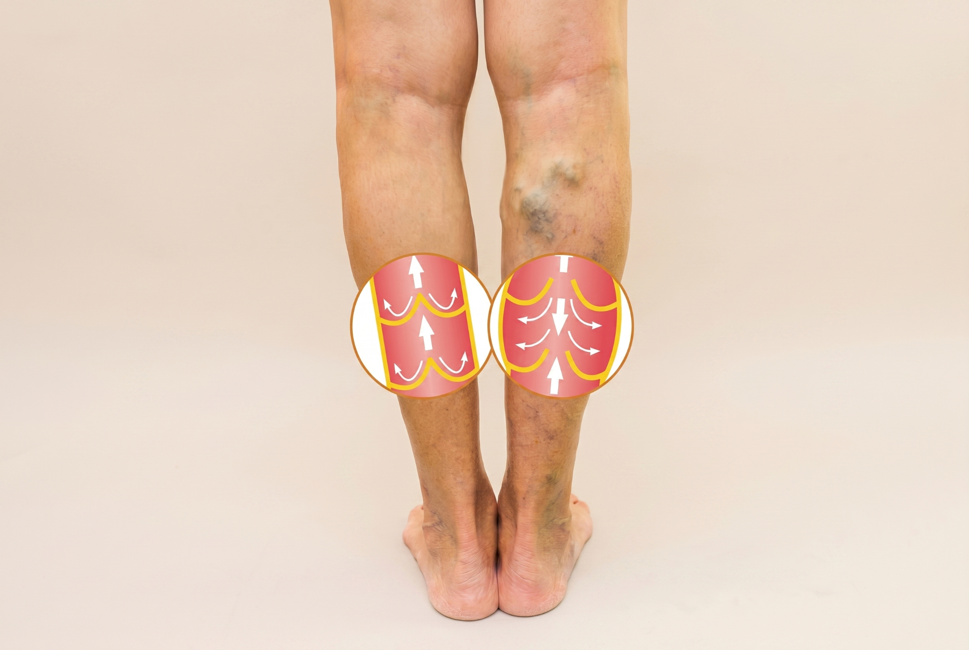 Healthy vein valves push blood up. Failed valves let blood fall back down and pool