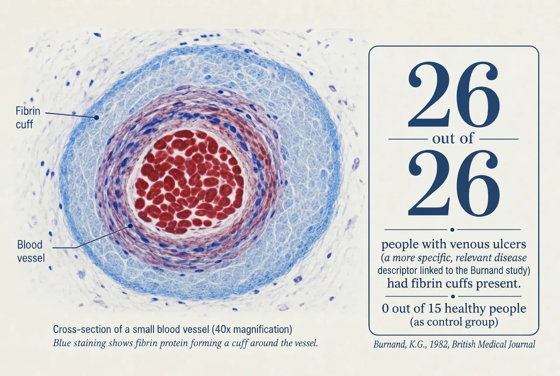 1982 study — fibrin layer found in all 26 patients with advanced vein problems, zero in healthy controls